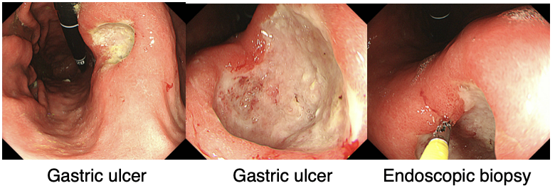 Endoscopic procedure