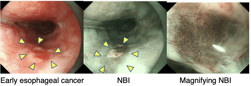 Endoscopic procedure