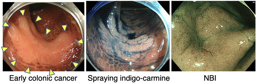 Endoscopic procedure