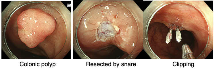 Endoscopic procedure
